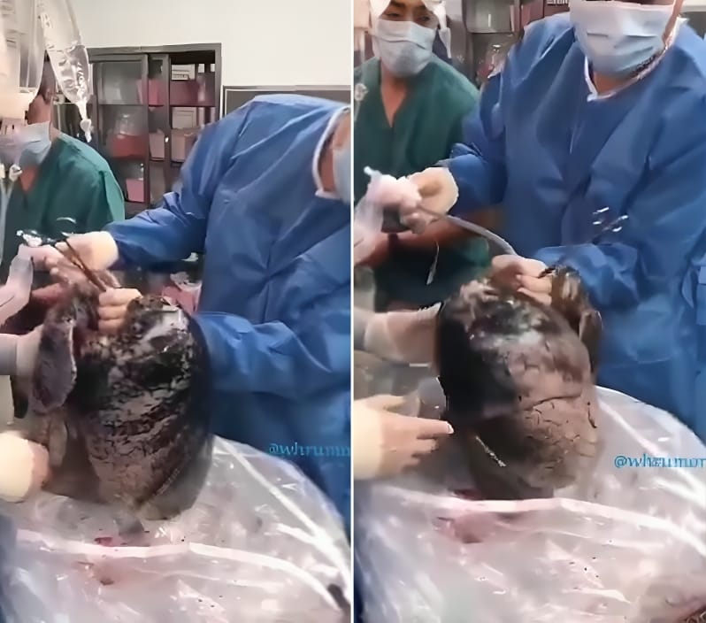 شاهد.. رئة شخص استمر بالتدخين لمدة 30 عاما وتوفي بسبب السرطان